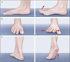 Bunions develop when bone or tissue at the joint on your big toe shifts out of place. Quick And Easy Foot Exercises For Bunions Insync Physiotherapy
