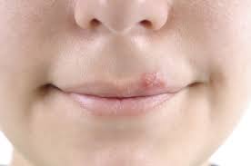 Cold Sores Harvard Health