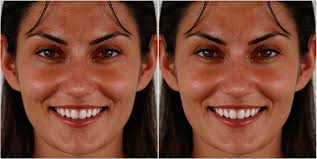 Layperson's perception of axial midline angulation in asymmetric faces