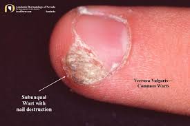 Image result for verrucae filiformes