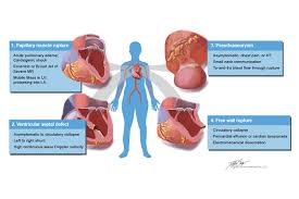 Image result for Post-MI Pericarditis