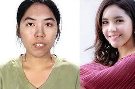 Mulanya Tonggos dan Jelek, Gadis Thailand Jadi Super Cantik