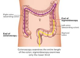 Image result for Colon Cancer Screening with Colonoscopy