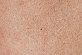 Image result for Trombicula autumnalis bites