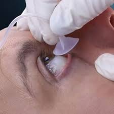 Image result for Eye Irrigation