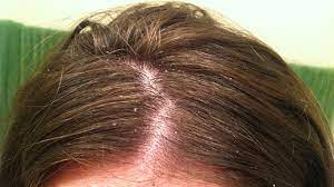 Spirulina powder growth before and after. Benefits Of Spirulina Uses Dosage Side Effects