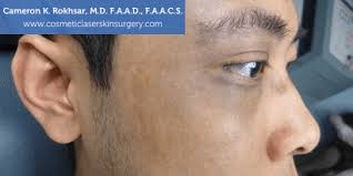 Birthmarks Removal Before and After Photos • Dr. Cameron Rokhsar