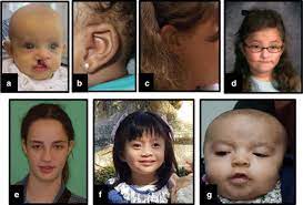 De Novo Loss Of Function Variants In X Linked Med12 Are Associated With Hardikar Syndrome In Females Genetics In Medicine