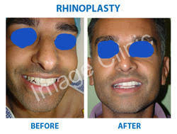All accounts say it's nearly painless. Nose Surgery In New Delhi Vasant Vihar By Image Clinic Id 11898157655