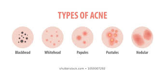 Types Of Acne Images Stock Photos Vectors Shutterstock