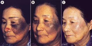 John Libbey Eurotext European Journal Of Dermatology Treatment Of Ota S Nevus Using Two Different Types Of Ruby Lasers