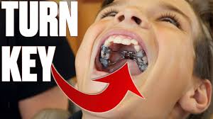 Just as with braces, plaque can build up where the palate expander connects with the teeth. Getting Braces For The First Time Expander With Turning Key Making Room For More Teeth Youtube