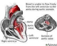 Image result for icd 10 code for i35.0