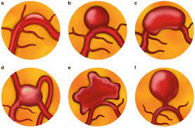 Diabetes factsheet from who providing key facts and information on types of diabetes, symptoms, common consequences, economic impact diabetes can be treated and its consequences avoided or delayed with diet, physical activity, medication and regular screening and treatment for complications. Diabetic Retinopathy Springerlink