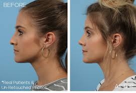 See rhinoplasty clinics, compare prices and find rhinoplasty surgeons. Charlotte Age 27 Female Rhinoplasty Case 306 Before After Plastic Surgery Charlotte Plastic Cosmetic Surgeon Aesthetic Surgery Of Charlotte