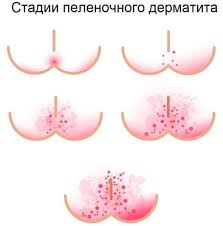 Kak Ubrat Oprelost U Mladenca Oprelosti U Novorozhdennyh Prichiny Lechenie I Profilaktika Simptomy I Priznaki