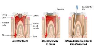 When can i return to work following root canal treatment? Root Canal Treatment Northbrook Advance Family Dental Care