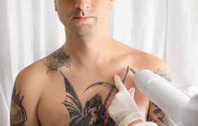 Two levels of wounds were made (shallow and deep). How Long Does Laser Tattoo Removal Take The Cosmetic Vein Laser Center