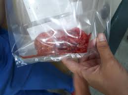 Serendah rm 50++ saja sebulan wehh 😱. Perut Buncit Macam Wanita Mengandung Kedua Dua Ovari Rahim Dibuang Berpunca Ketulan Cyst Merbahaya Mingguan Wanita