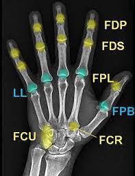 Below 400% fpl but above 300% fpl, the payback cap is $1275. Flexor And Extensor Insertions At The Hand And Wrist Radiology Case Radiopaedia Org