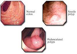 Preparing for a colonoscopy can be a hassle, but worth it. Colon Cancer Screening Endoscopy Colonoscopy Dallas Plano Cost