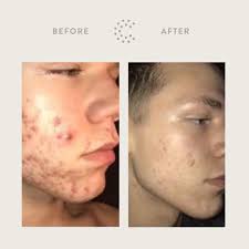 7 Months Between This Incredible Before And After Scar Face Skin Care