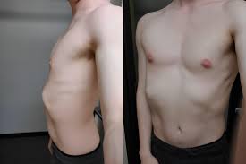 Don't ignore your rib abnormality. What Are Some Good Exercises To Diminish Rib Flare It Has Destroyed My Confidence Pectusexcavatum