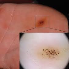 Check spelling or type a new query. Brown Black Punctate Macule On The Left Palm Mdedge Dermatology