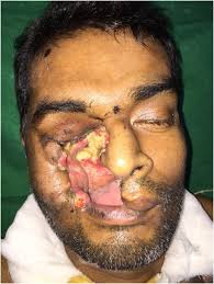 It is ubiquitous and found in soil. Cranio Facial Mucormycosis The Plastic Surgeon S Perspective Springerlink