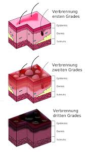 Geben sie uns feedback zu legionellose. Verbrennung Medizin Wikipedia