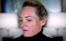 From TCA Peel Beginner to Pro: My Journey & Updated Routine BELOW