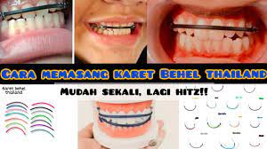 Warna behel ini bening, menyamai warga gigi sehingga orang lain tidak mengetahui bahwa anda mengenakan behel gigi/. Cara Memasang Karet Behel Kekinian Karet Behel Thailand Yang Sedang Hitz Mudah Sekali Youtube