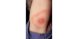 The ring grows outward as the infection spreads, and the center area becomes less actively infected. Lyme Disease Rashes And Look Alikes Lyme Disease Cdc