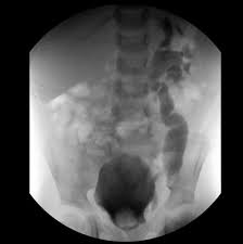 Image result for Voiding Cystourethrogram