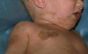 Others have also demonstrated the phenomenon of multiple calms without other. Birthmarks