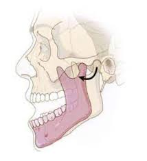 Image result for Jaw Dislocation
