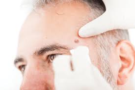 It starts when cells in the skin called. Trends In Merkel Cell Carcinoma Physician S Weekly