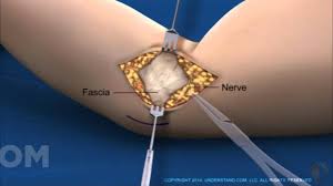 Tommy john surgery is a procedure to repair an injured elbow ligament. Understand Com New Ucl Reconstruction Tommy John Surgery Animation Youtube