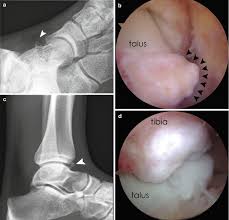 Small well corticated bony fragments lies at the anterior aspect of the medial malleolus. Anterior Ankle Impingement Springerlink