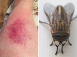 Jika terjadi iritasi kulit, hentikan perawatan ini. 7 Jenis Gigitan Serangga Yang Harus Diwaspadai Wajib Tahu