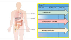 We did not find results for: Targeted Therapy Immunotherapy Bowel Cancer Australia