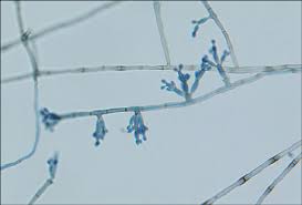 Sasp is synthesized during sporulation and it binds to dna in core and protect it from potential damage caused by uv radiation. Chromoblastomycosis Caused By Fonsecaea Pedrosoi