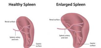 Blood exits this organ through the splenic vein. Ù…Ø§ Ù‡Ùˆ ØªØ¶Ø®Ù… Ø§Ù„Ø·Ø­Ø§Ù„ ÙˆØ¹Ù„Ø§Ø¬Ù‡ Ù…ÙˆØ¶ÙˆØ¹