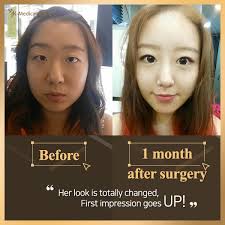 Jk Plastic Surgery In South Korea Korean Plastic Surgery Best Plastic Surgery In Korea Extreme Plastic Surgery In Korea Best Plastic Surgery Clinic In Korea Kor
