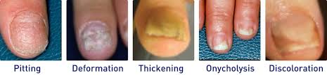 Image result for Pitting nails feet