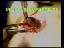 En pratique, pour une intervention chirurgicale d'une hernie inguinale, deux techniques opératoires existent : Pret Operatie Hernie Inghinala Bucuresti Move Flex Gel In Romania