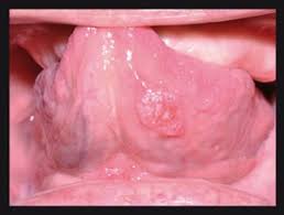 Image result for white cancer on tongue)