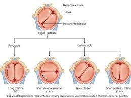 Image result for Manual Rotation in Occipitoposterior Presentation