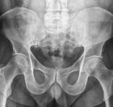 Image result for Hip XRay