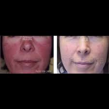 We did not find results for: Ipl Treatment For Rosacea And Broke Capillaries In Perth